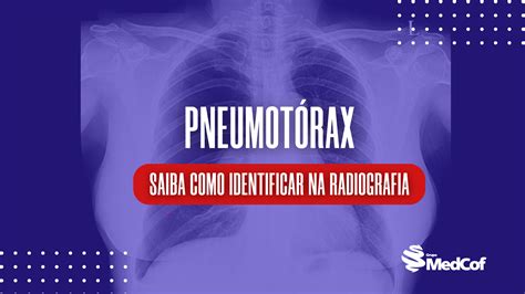 Pneumotórax traumático ou espontâneo Blog Grupo MedCof