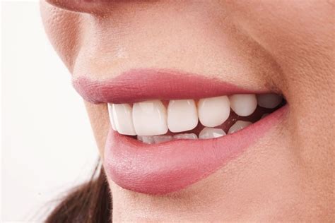 How Do Veneers Work Dental Boutique