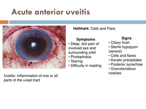 Ciliary Flush Vs Conjunctivitis