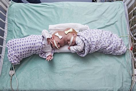 In Rare Procedure Chop Surgeons Separate Twin Girls Conjoined At The Head Phillyvoice