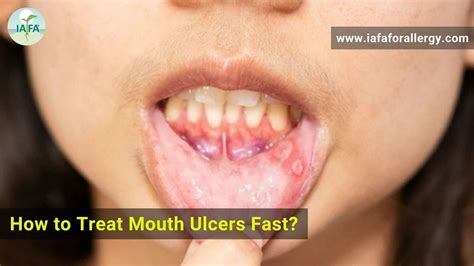 Mouth Ulcers Types Causes Treatment 55 Off