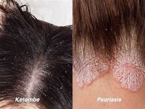 Tampak Mirip Ini Perbedaan Ketombe Dan Psoriasis Kulit Kepala