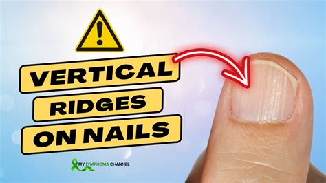 What Causes Vertical Ridges On Nails Youtube