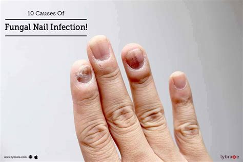 Fungal Nail Infection Causes - Nail Ftempo