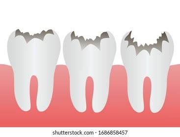 Dental Cartoon Vector Stages Tooth Decay Stock Vector (Royalty Free ...