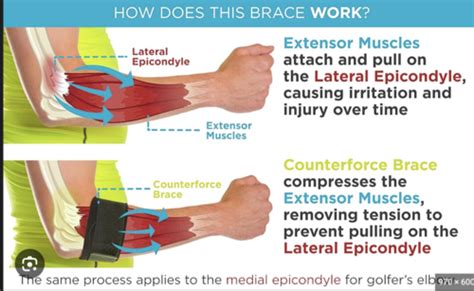 MSK Elbow Conditions Flashcards Quizlet