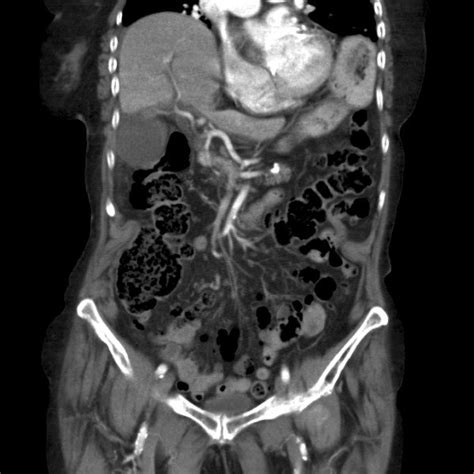 Torsion Of The Gallbladder Peroperative Endoscopic Image Showing A Download Scientific Diagram