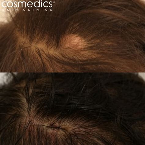 Pilar Cyst Removal Clinics London Cosmedics Skin Clinics