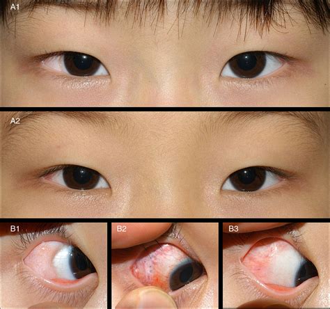 Early Results Of Surgical Management Of Conjunctival Dermolipoma