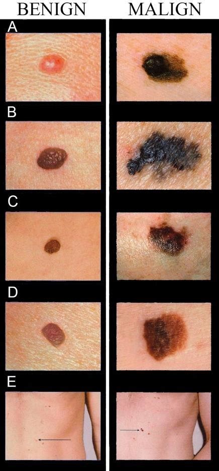 Malignant Melanoma Abcde