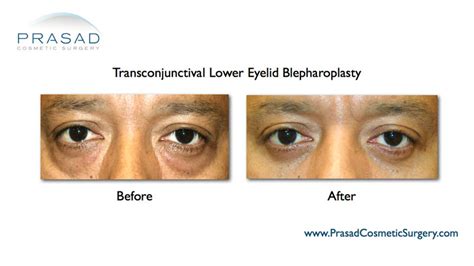 Eye Bag Removal Surgery: Procedure, Risks, Recovery