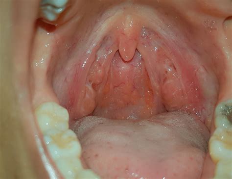 Bumps On Tonsils