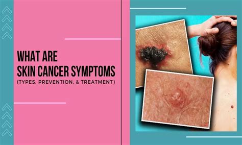 Skin Cancer Symptoms Causes Skin Cancer Symptoms And Prevention