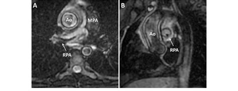 A B Axial And Sagittal Black Blood T2 Weighted Fast Spin Echo Images