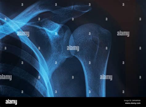 Radiographie Thoracique Normale Banque De Photographies Et Dimages