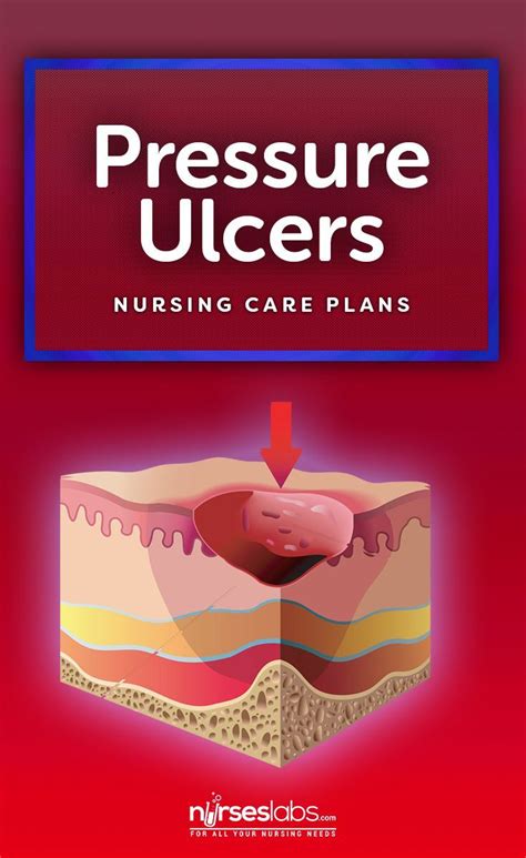 Stage 2 Pressure Ulcer Nursing Care Plan