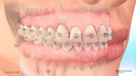 What Are The Benefits Of Metal Carriere SLX Braces Pesh Orthodontics