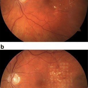 Fundus Photograph Demonstrating Clinically Significant Macular Oedema