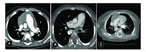 A Right Proximal Interruption Of The Pulmonary Artery Pipa In A