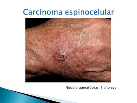 Carcinoma Basocelular Y Espinocelular Ppt