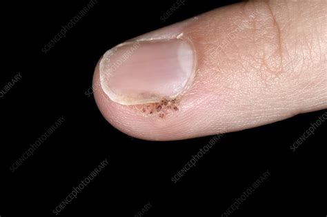 Wart On Finger