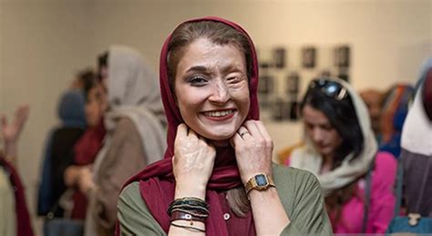 The Face Of Courage Acid Attack Survivor Marzieh Ebrahimi