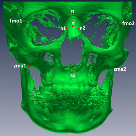 Three Way Anova For Facial Indices With Sex Growth And Sagittal