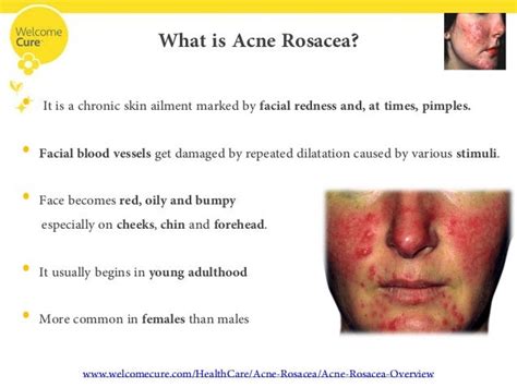 Acne Rosacea- The Disease, Its Complications And Homeopathic Treatment