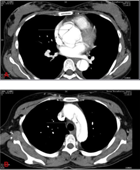 Aortic Dissection Concise Medical Knowledge