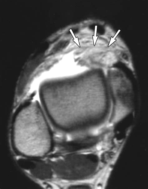 Anteromedial Impingement Of The Ankle Using Mr Arthrography To Assess