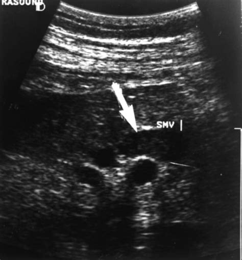 The Doppler ultrasound showed partial thrombosis of the superior ...