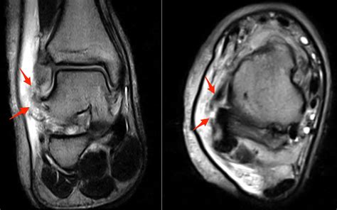 Calcaneofibular Ligament Injury | coachingultrasound