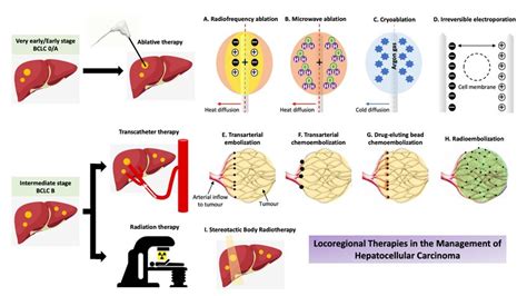 Locoregional Therapies In The Management Of Hcc Bclc Barcelona Clinic