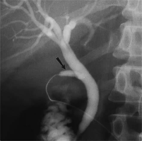 Operative And Laparoscopic Cholangiogram And Ercp Flashcards Quizlet