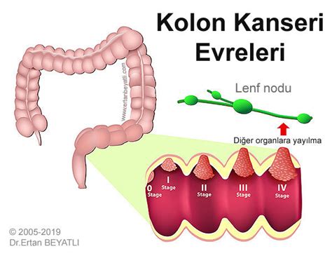 Kolon Kanserinin Belirtileri Ve Tedavisi Dr Ertan Beyatli