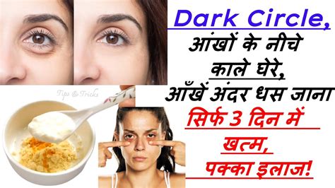 Dark Circles Dark Circles Treatment आखों के काले घेरे हटाने के घरेलू