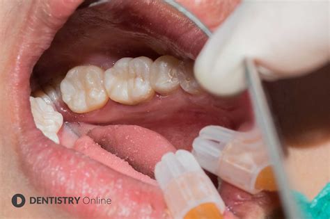 Restoring An Upper Left Molar With A Composite Filling Dentistry Online