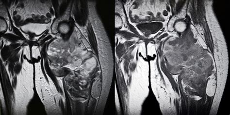 Sarcoma Of The Thigh Mri Stock Photo Download Image Now Istock