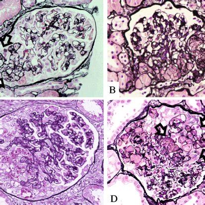 Local Intra Capillary Thrombi Are Associated With Podocyte Loss In The