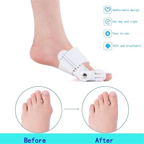 Orthopedic Bunion Corrector Device 2 Pieces Set Bunion Free