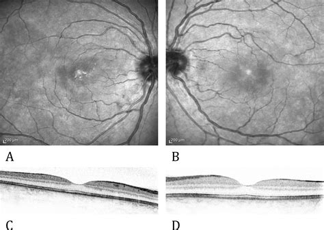 Probable Vogt-Koyanagi-Harada disease with granulomatous tattoo-related