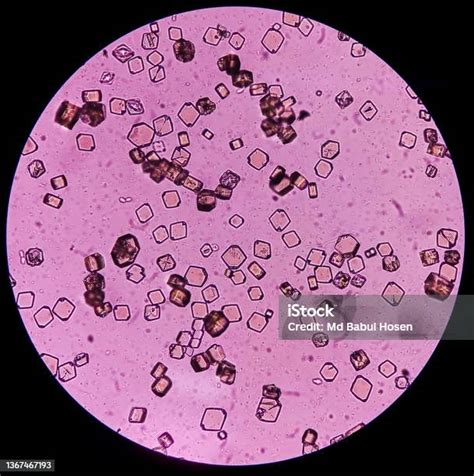 Uric Acid Crystals In Urine Sediment Its Different Types Of Shapes