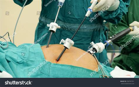 Laparoscopic Cholecystectomylc Mean Gallbladder Surgery Stock Photo 358787351 | Shutterstock