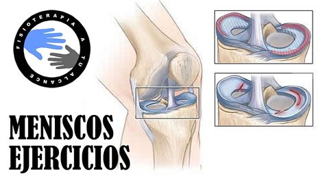 Rotura De Menisco Y Operacion De Meniscos Rehabilitacion Y Ejercicios