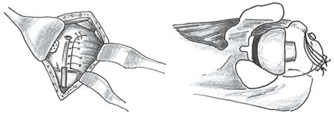 Systematic Review Of Lesser Tuberosity Osteotomy Techniques Outcomes