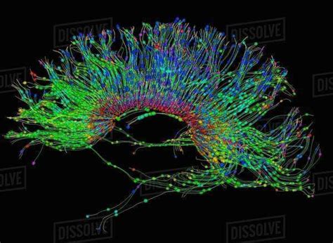 Diffusion Mri Also Referred To As Diffusion Tensor Imaging Or Dti Of