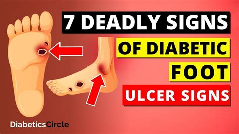 7 DEADLY Diabetic FOOT Ulcer Signs - Diabetes