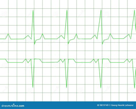 Ritmo Normal Del Corazón Stock De Ilustración Ilustración De Paciente 9819749