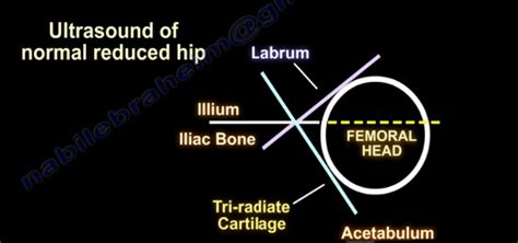 Dr. Nabil Ebraheim's Blogspot: Barlow & Ortolani Signs—DDH, Congenital Hip Dislocation