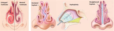 Septoplasty Procedure Steps